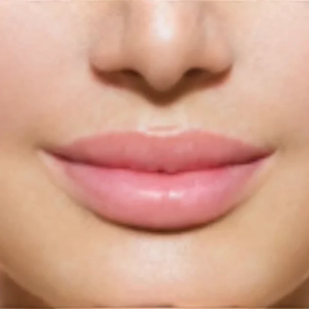 Lippen aufspritzen